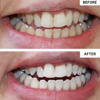 WellaWhite Electric Toothbrush user Ana K.