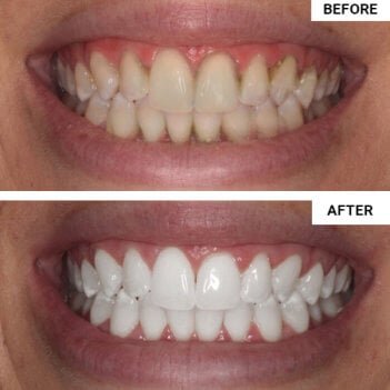 WellaWhite Electric Toothbrush user Jessica M.